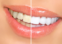 Teeth Whitening - Dentist In Glen Allen, VA | Campbell S. Delk, DDS
